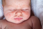 Trẻ bị phát ban sau khi sốt có nguy hiểm?