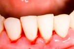 Biện pháp tự nhiên khắc phục chảy máu chân răng