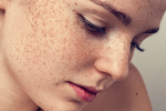Cẩm nang chăm sóc da: 3 loại tăng sắc tố da thường gặp