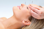 Châm cứu có giúp giảm đau đầu và đau nửa đầu? 