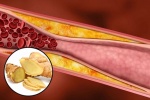 Gừng -  thảo mộc giúp loại bỏ mảng bám, ngăn ngừa xơ vữa động mạch