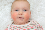 12 triệu chứng dị ứng trứng ở trẻ sơ sinh và trẻ nhỏ