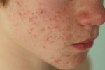Mùa Đông trên da mặt xuất hiện nhiều mụn li ti, điều trị thế nào?