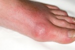 Bị đau nhức bàn chân, khó đi lại, có phải bị bệnh gout không?