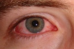 Ngứa mắt, đỏ mắt: Coi chừng bị viêm kết mạc mùa Xuân