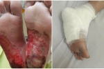 Bệnh nhân đái tháo đường bỏng chân vì dùng đèn sưởi đá muối Himalaya 