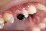Nguyên nhân nào gây sâu răng?