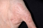 Những biện pháp đơn giản giúp điều trị eczema