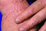 Làm sao để giảm sẹo khi bị eczema?