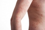 Những biện pháp tự nhiên giúp cải thiện triệu chứng eczema