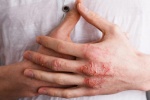 Làm thế nào để tránh eczema bùng phát nếu không có thuốc steroid?