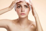 6 lưu ý khi trị mụn cho người có làn da khô