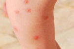 9 cách đơn giản giúp giảm sưng ngứa do muỗi đốt