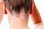 Làm thế nào để điều trị bệnh vẩy nến da đầu?