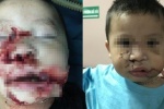 Bé trai 2 tuổi bị chó cắn nát mặt được tạo hình thành công
