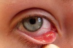 4 bệnh về mắt thường gặp trong mùa Hè