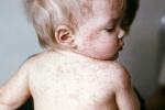 Triệu chứng bệnh sởi ở trẻ: Đừng nhầm với cảm lạnh hay sốt phát ban!