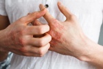 7 cách đơn giản giúp phòng ngừa eczema