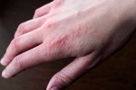 6 quan điểm sai lầm về bệnh eczema