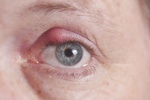 8 cách điều trị lẹo mắt hiệu quả tại nhà