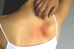 Eczema tái phát trị dứt điểm cách nào?