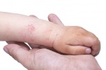 Trẻ bị bệnh eczema nặng phải làm sao?