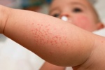 10 cách khắc phục bệnh eczema ở trẻ em