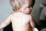 Trẻ bị sốt và nổi mẩn đỏ có phải bị bệnh sởi? 