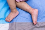 Những biến chứng nguy hiểm của bệnh tay chân miệng ở trẻ