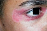 Biến chứng bệnh vẩy nến ảnh hưởng đến mắt như thế nào?