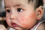Trẻ 5 tháng tuổi bị eczema phải làm sao? 