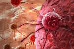 Nhiễm vi khuẩn có dẫn đến ung thư? 