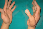 Phẫu thuật chuyển ngón chân thành ngón tay cái