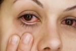 5 nguyên nhân khiến mắt bạn bị đỏ
