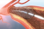 Stent là gì, khi nào người bệnh thiếu máu cơ tim nên đặt stent mạch vành?