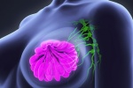 Liệu pháp mới giúp biến tế bào ung thư vú thành mỡ