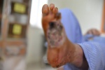 Gia tăng bệnh nhân đái tháo đường nhập viện vì biến chứng bàn chân