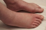 5 nguyên nhân khiến bàn chân bị sưng