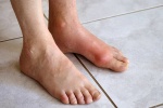 Những căn bệnh dễ nhầm với bệnh gout