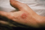 Những biện pháp tự nhiên giảm eczema