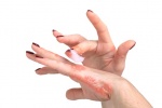 Cách giảm eczema trên bàn tay