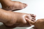 6 nguyên nhân gây sưng bàn chân, mắt cá chân