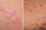 9 dấu hiệu cho thấy bệnh eczema của bạn đang trở nên nghiêm trọng