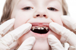 Phòng ngừa và điều trị sâu răng ở trẻ có khó khăn?