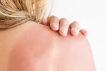 8 biện pháp tự nhiên giúp khắc phục làn da cháy nắng