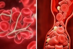 6 cách đơn giản giúp ngăn ngừa cục máu đông 