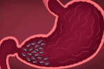 5 dấu hiệu cảnh báo bạn bị viêm loét dạ dày do nhiễm khuẩn HP