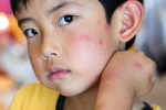 3 bước đơn giản giúp điều trị vết côn trùng cắn ở trẻ 