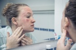 Làm sao để giảm vẩy nến trên khuôn mặt?