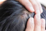 5 phương pháp giúp điều trị bệnh vẩy nến da đầu hiệu quả